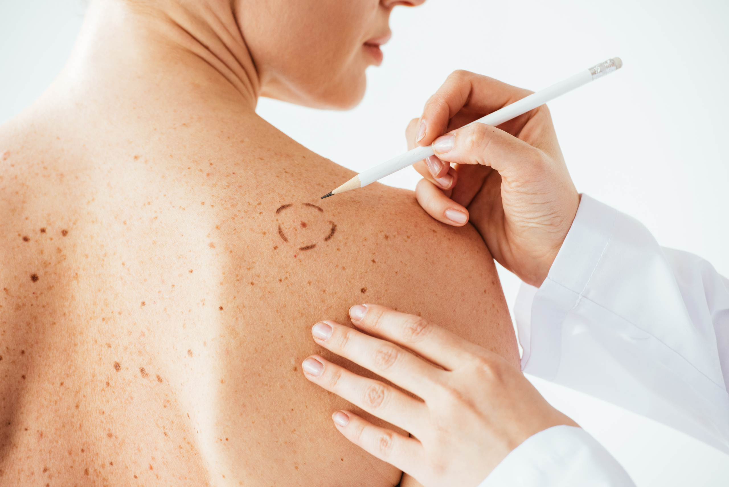 cropped view of dermatologist applying marks on skin of woman with melanoma isolated on white