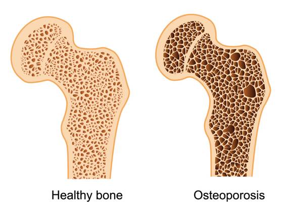 drawing showing a healthy bone vs a bone with osteoporosis